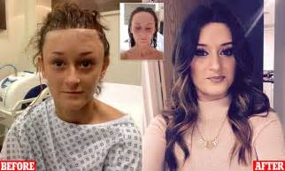 Kent Woman Bullied For Large Forehead Got £6500 Surgery Daily Mail