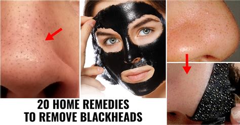 20 Home Remedies To Remove Blackheads