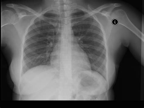 Normal PA Chest X Ray Dr Yale Rosen Atlas Of Pulmonary Pathology