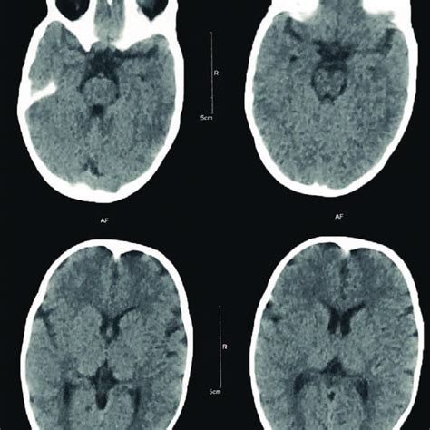 Ct Of The Brain Showing Left Cp Angle Arachnoid Cyst Download