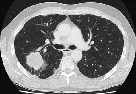 A Rapidly Growing Lung Mass With Air Crescent Formation Thorax