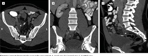 Figure 1 From Acute Abdominal Pain And Abnormal Ct Findings Semantic