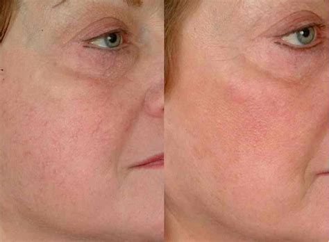 Facial Redness And Vein Laser Treatments Mgmd Dermatology
