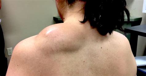 Dr Pimple Popper Takes On An Enormous Lipoma On A Patients Back So