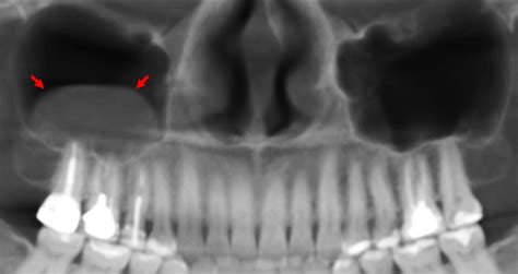 Pseudoquiste Antral Dento Metric Radiología Dental Oral Y Maxilofacial