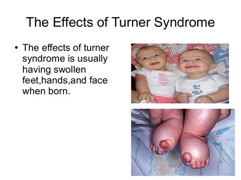 Gb Turner Syndrome