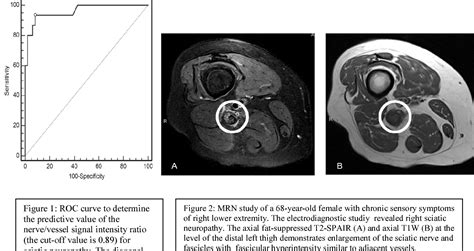 3 T High Resolution Mr Neurography Of Sciatic Neuropathy Semantic