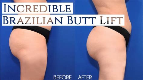 Incredible Brazilian Butt Lift Bbl Before After Youtube