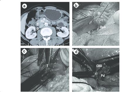 Main Surgical Technique Of Tda A Preoperative Ct Image Showed The