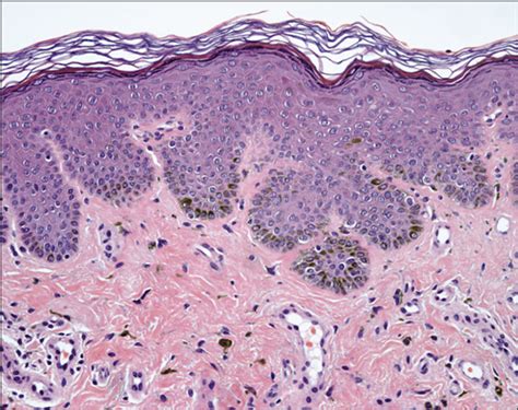 Reticulate Genital Pigmentation Associated With Localized Vitiligo