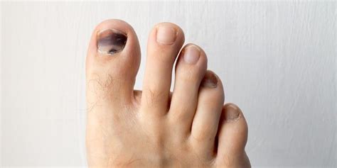 5 Reasons Youre Dealing With A Black Toenail According To A