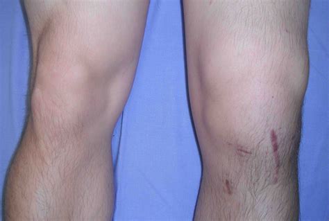 Knee Infection Pictures Picturemeta