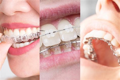 Ceramic Braces Vs Invisalign For Better Or For Worse Knowledge For