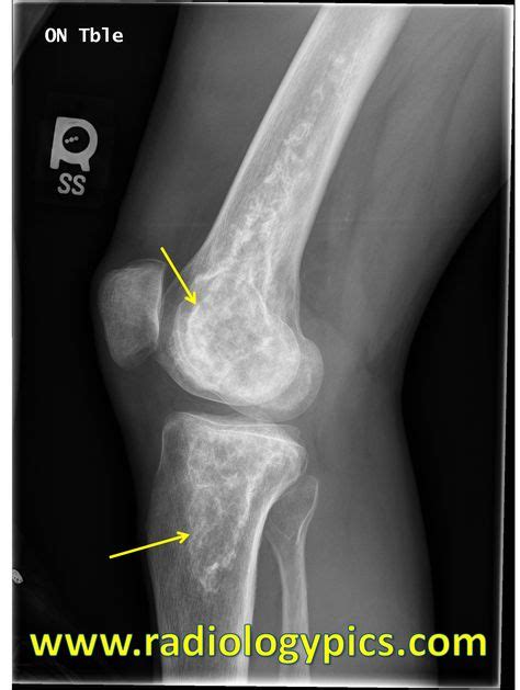 Osteonecrosis Of The Knee Lateral Radiograph Of The Right Knee