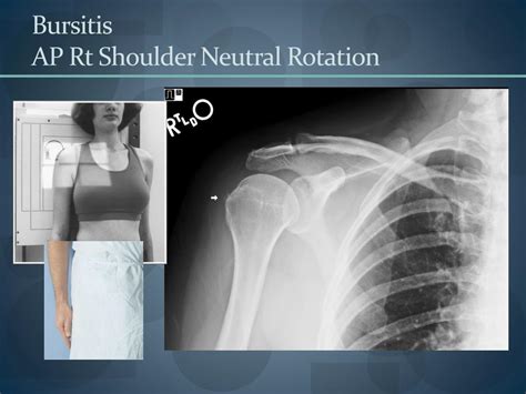 Ppt Shoulder Girdle Powerpoint Presentation Free Download Id5740918