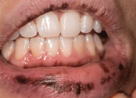 Hyperpigmented Lip Lesions Differntial Diagnosis Dermatology Games