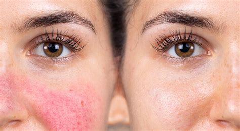 5 Signs Your Blotchy Skin Might Be Allergies 100 Pure
