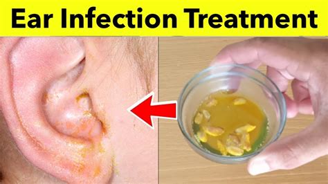 How To Cure Ear Infection Naturally At Home Best Home Remedies For Ear Infection Treatment
