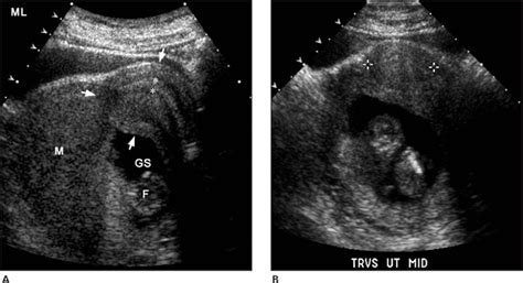 Retroverted Uterus Pregnancy