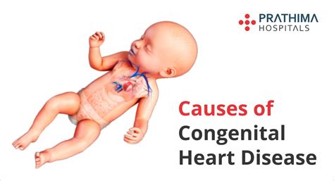 Know About Congenital Heart Disease Prathima Hospitals