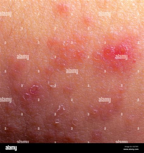 La Dermatite Atopique Eczéma Peau Texture Détail Symptôme Photo Stock