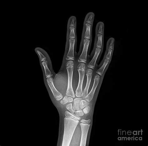 Broken Wrist Bone X Ray Photograph By Science Photo Library