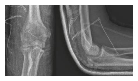 Patient Number 4 Postoperative X Rays Osteochondral Fragment Reduced