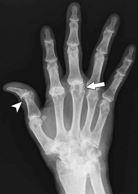 Differentiating Rheumatoid And Psoriatic Arthritis Of The Hand