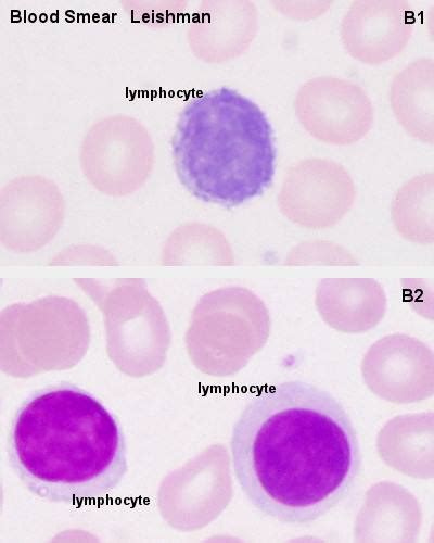 Small Vs Large Lymphocytes Medical Laboratories