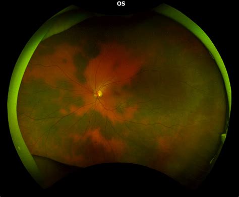 Bilateral Benign Isolated Choroidal Melanocytosis Canadian Journal Of