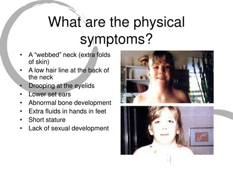 Ppt Turner Syndrome Powerpoint Presentation Free Download Id3085707