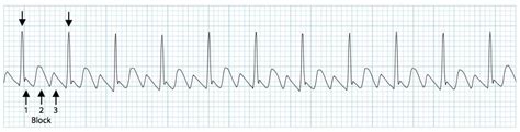 Top Atrial Flutter To