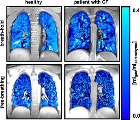 Functional Mri Of The Lungs Using Single Breath Hold And Self Navigated