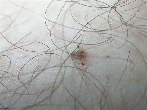 Lice Pictures Symptoms Faqs