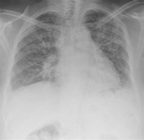 Prognosis After Acute Exacerbation In Rheumatoid Arthritis Ild Vs Ipf