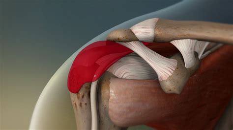Shoulder Bursitis Causes Symptoms Diagnosis And Treatment Scope Heal