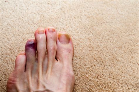 Big toe injuries can be more problematic than you think surgeons warn — don't underestimate an injured or broken toe. Health Tip: Help a Broken Toe Heal