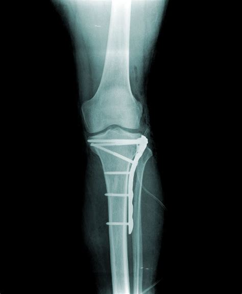 Tibial Plateau Fracture X Ray