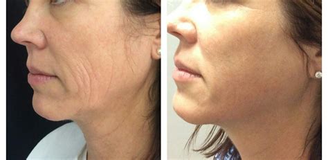 Pdo Facial Threading To Lift And Tighten The Face Charles Small Is The