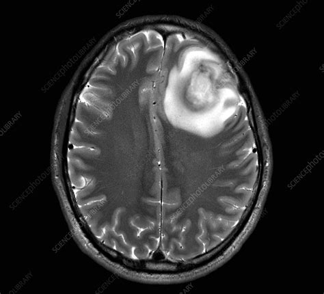 Brain Abscess Ct Scan Stock Image C0529339 Science Photo Library
