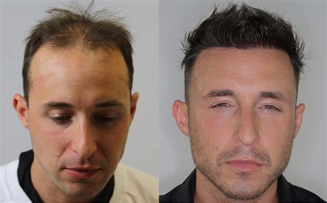 Right oblique view before and after with regular hair cut*. 3000 FUE Graft Hairline Restoration - Alvi Armani - Hair ...