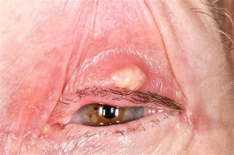 Eyelid Cyst