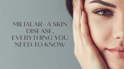 Milialar A Skin Disease Everything You Need To Know