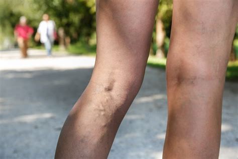 How Does Laser For Varicose Veins Work Vein Clinic Perth