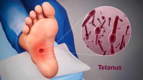 Clostridium Tetani Symptoms