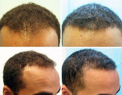 Hair transplant costs also depending on the amount of transplanted grafts. Black Men FUE Hair Transplant Using 1200 grafts