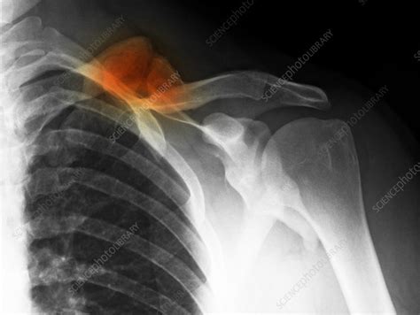 Healed Clavicle Fracture Stock Image C0094788 Science Photo Library