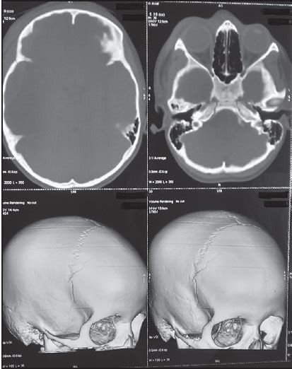 Ipsilateral Double Extradural Hematoma In A Child An Uncommon Case