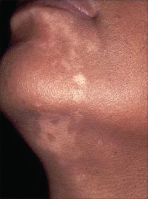 Unilateral Depigmentation Segmental Vitiligo On The N