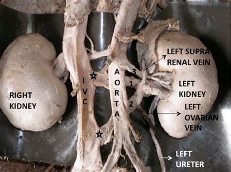 Figure 1 From Retro Aortic Left Renal Vein An Anatomic Variation